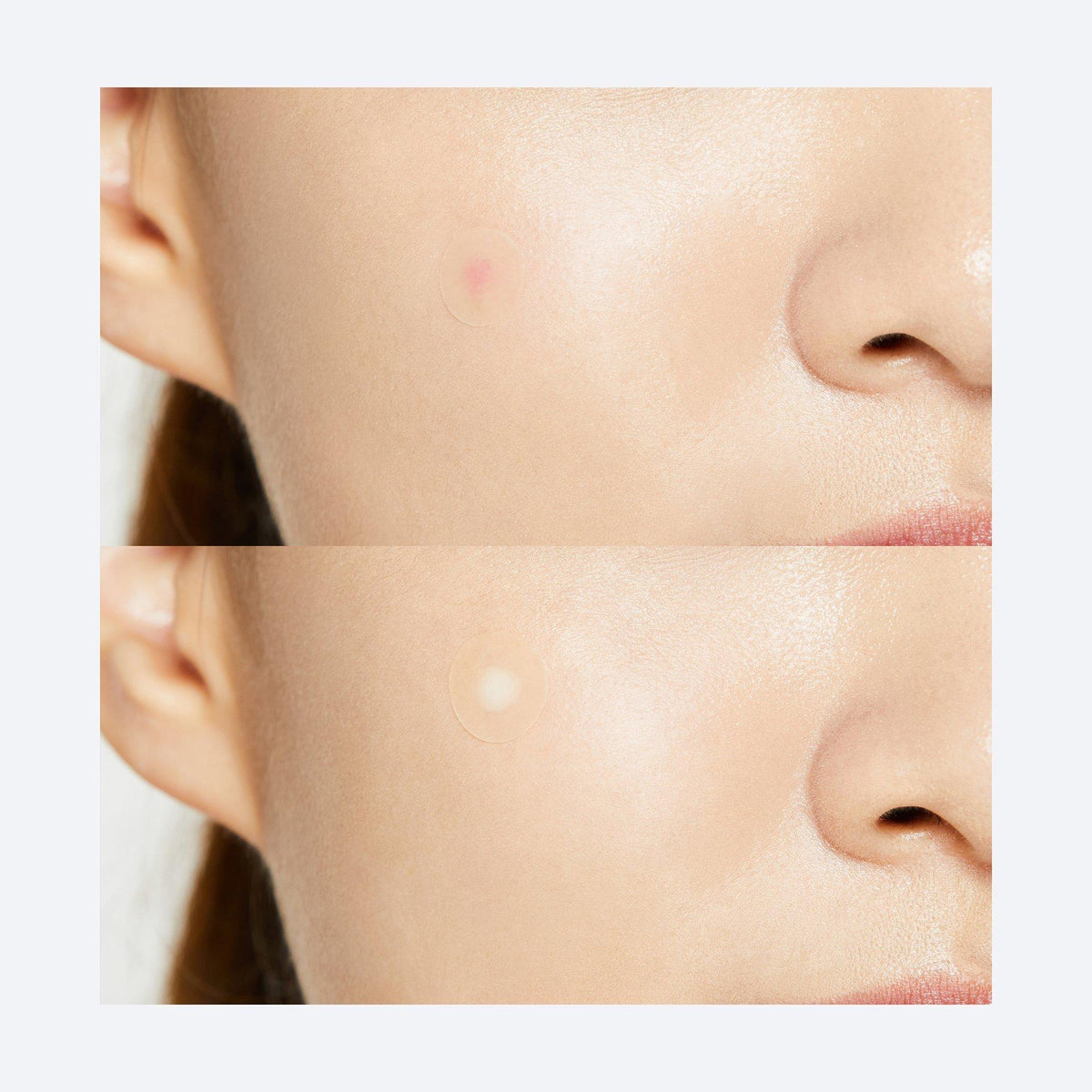 Acne Pimple Master Patch - Original Care