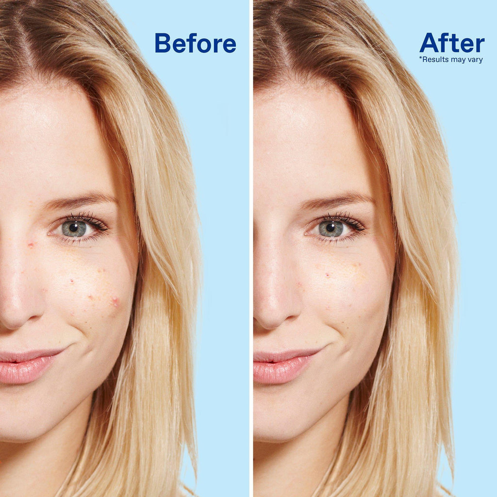 5% Benzoyl Peroxide Daily Deep Cleanser