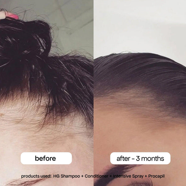 Intensive Spray Daily Scalp Serum for Thinning Hair with Rosemary
