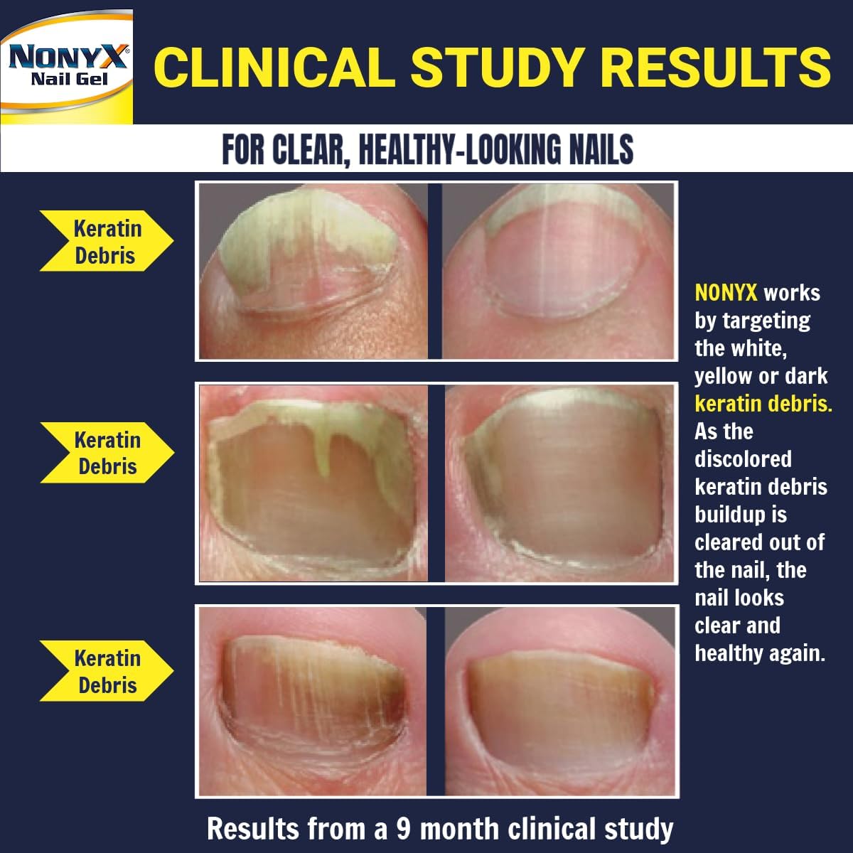 NONYX Fungal Nail Clarifying Gel | Clinically Proven for Discolored, Thick, Brittle, Yellow, Lifted, and other signs of Fungus-Damaged Toenails | 90%