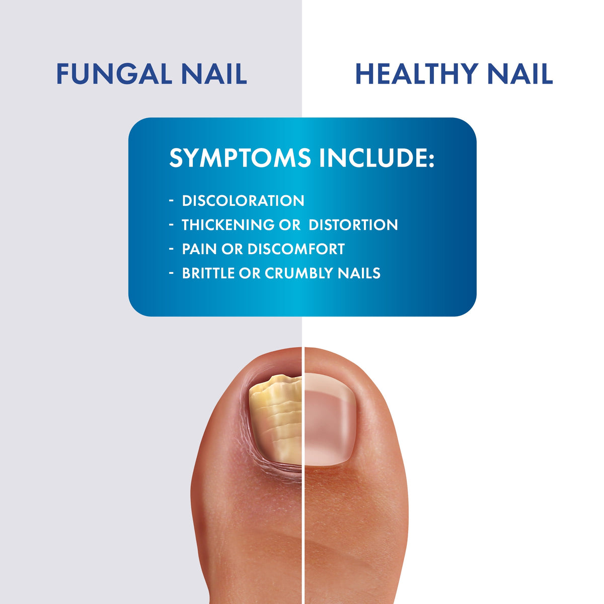 ProClearz Fungal Shield Maximum Strength Brush-On Antifungal Liquid, 1 oz