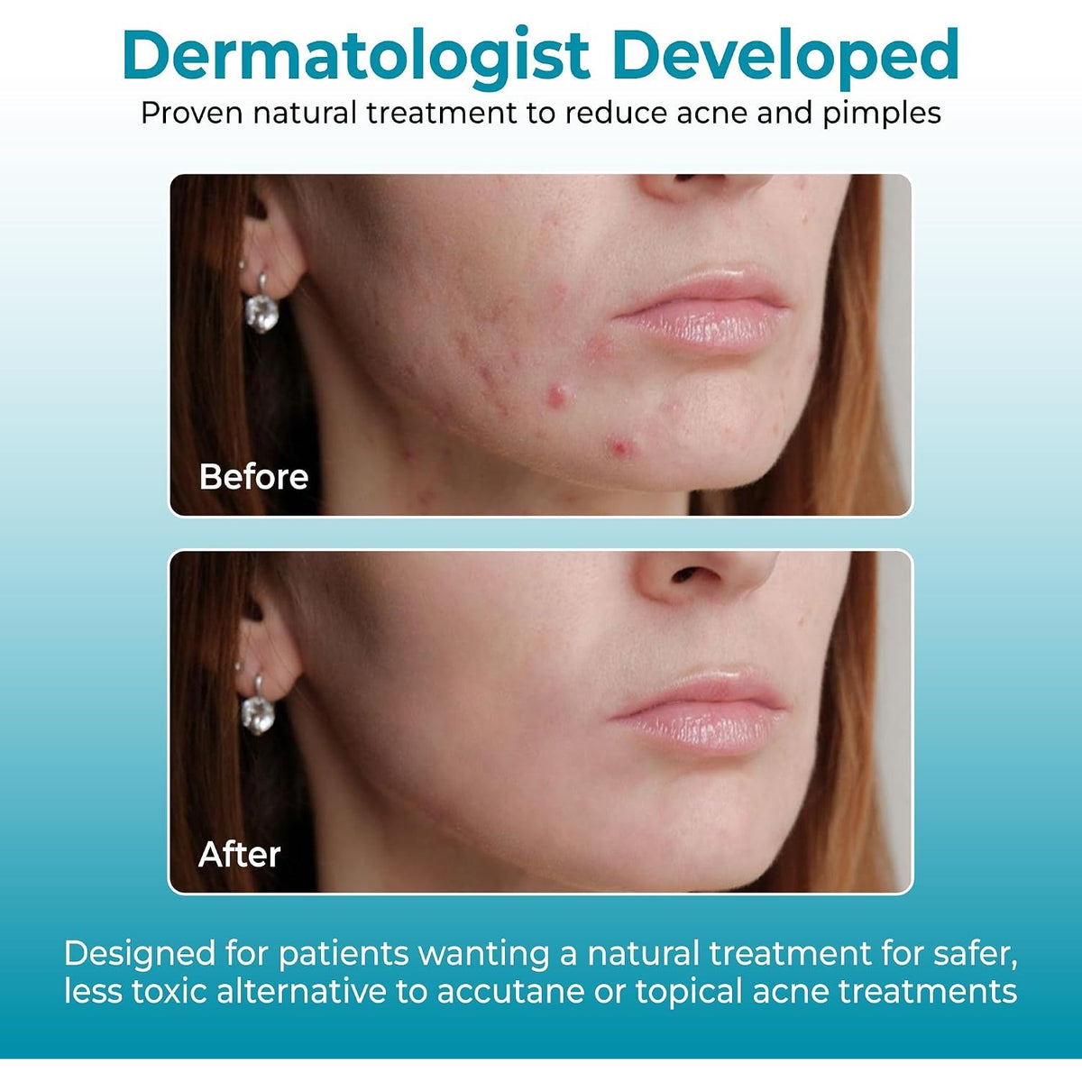 Loma Lux Acne Pills with Zinc & Sulfur for Hormonal Acne & Oily Skin
