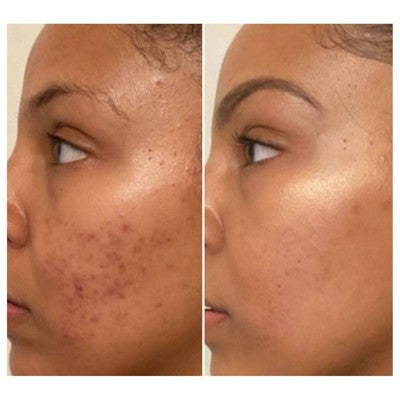 Urban Skin Rx 3-in-1 Even Tone Cleansing Bar - 2.0oz