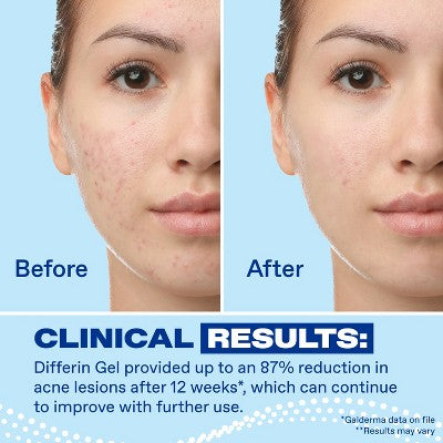 Differin Acne Retinoid Treatment Gel Adapalene 0.1%