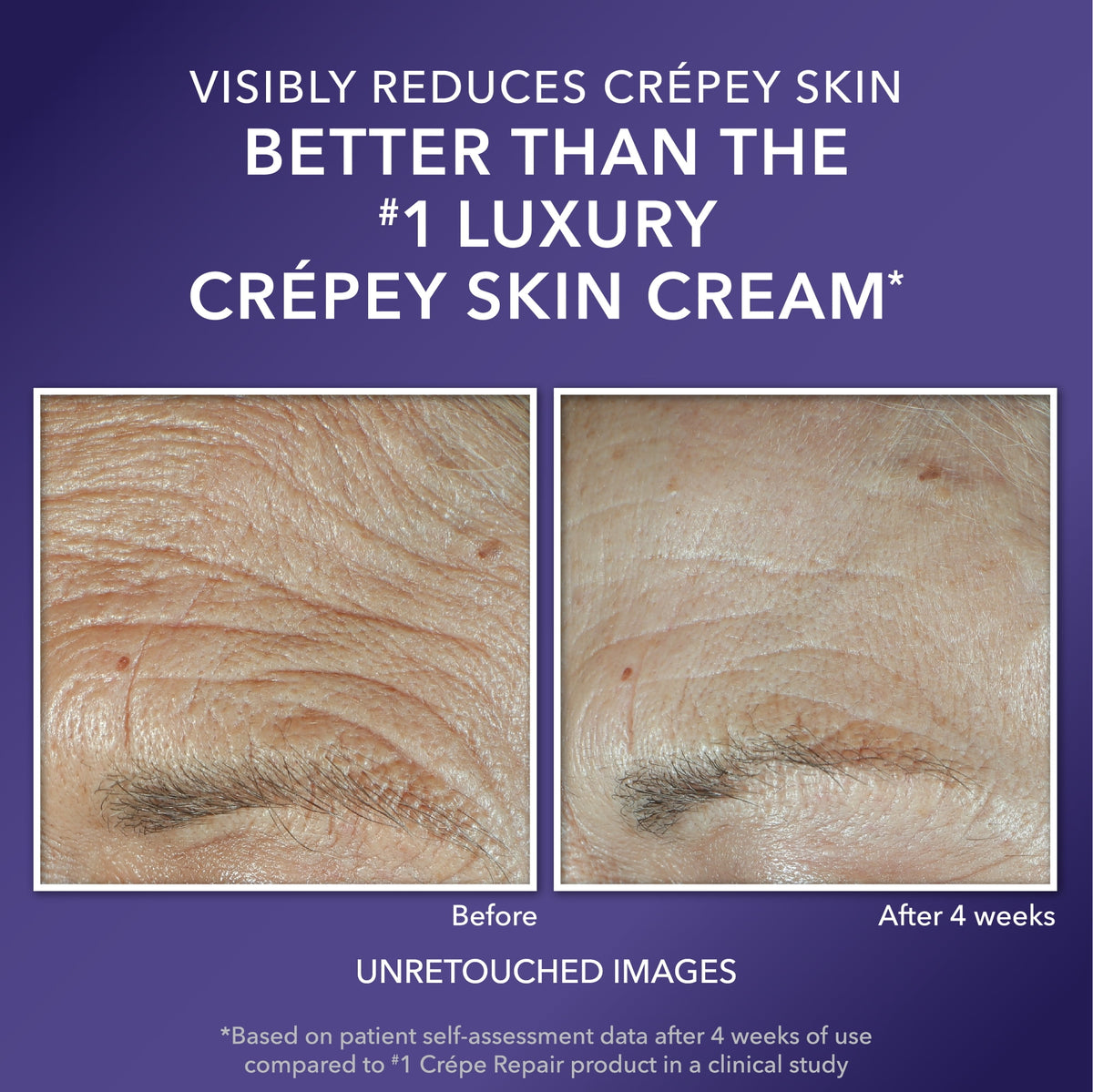 Roc Multi Correxion Anti-Aging Moisturizer, Firming Cream for Dry & Crepey Skin, 1.7 oz