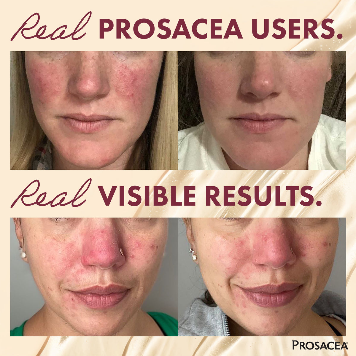 Prosacea Gel for Rosacea Redness, Pimples, and Irritation, Sulphur 1x, 0.75 oz Tube
